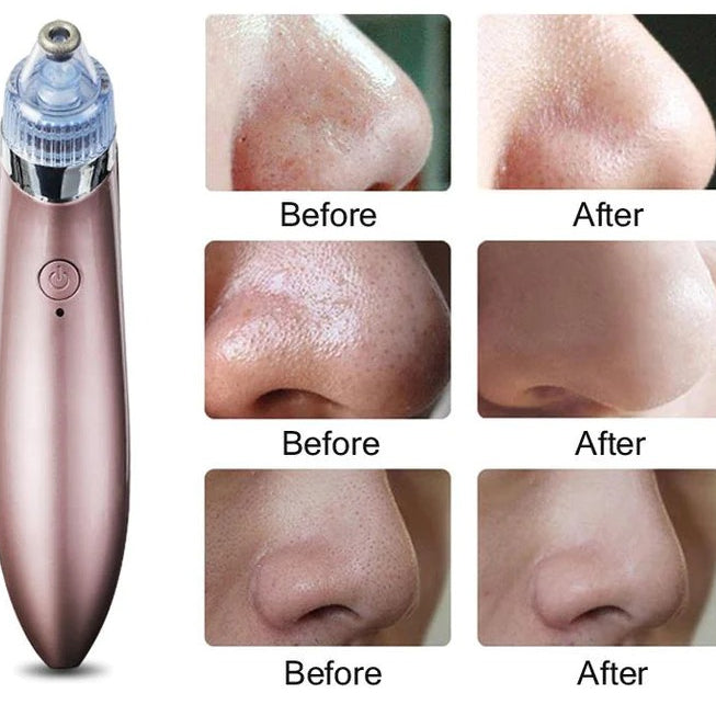 GlowSkin™ Portable Blackhead Remover